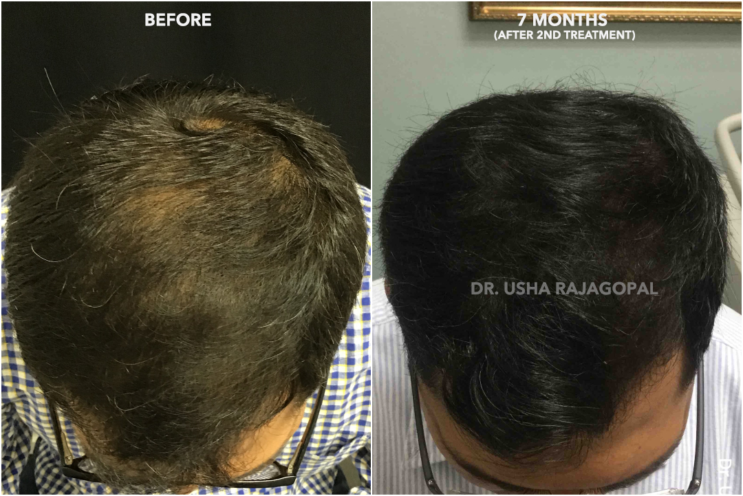 PRP Treatment for hair growth with 30 ml hair serum  Skin Hair and Pain  Treatment