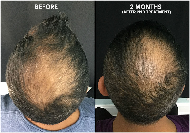 PRP + ACell Hair Regrowth Before and After