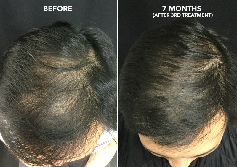PRP + ACell Hair Regrowth Before and After