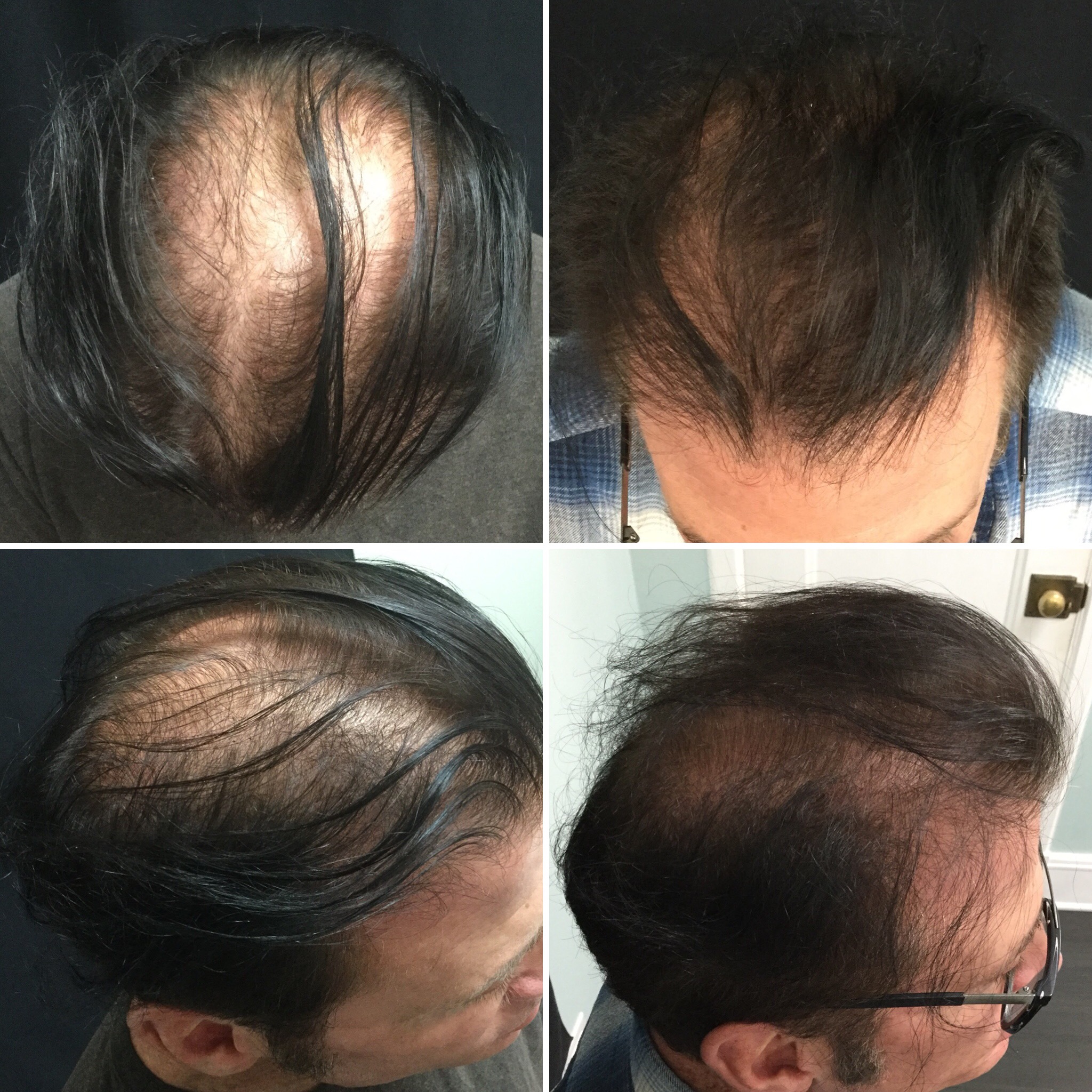 PRP + ACell Hair Regrowth Before and After