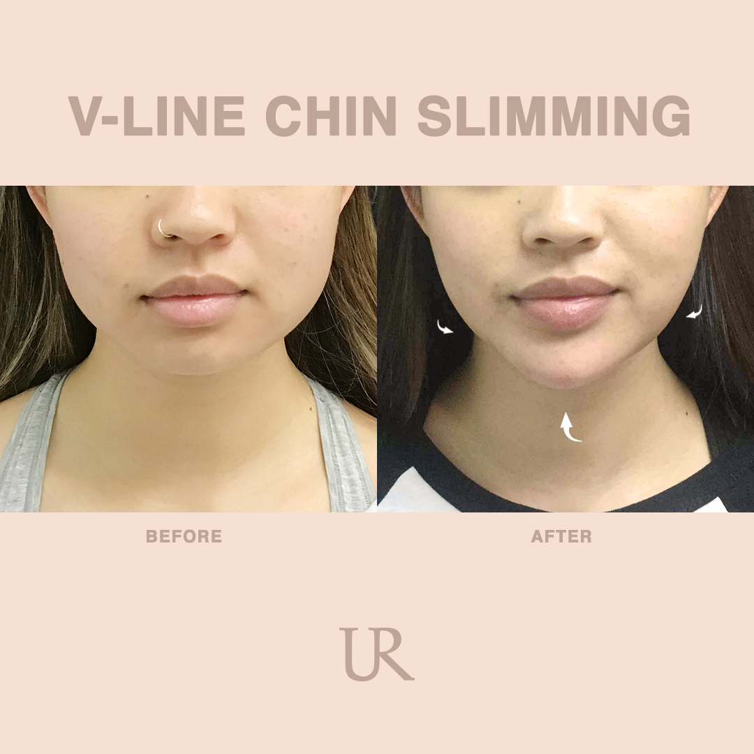 V-Line – Face Slimming using Botox (Asian Cosmetic Surgery)