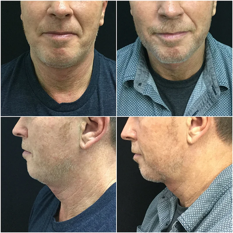 Dr. Usha Rajagopal’s Kybella Patient Results