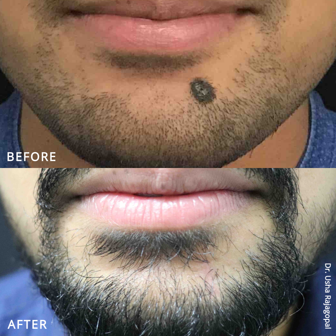 Mole Removal Excision 4 Months Post Treatment