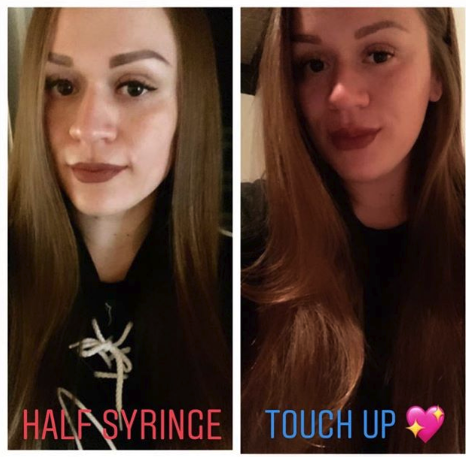 Lip Injections Before and After