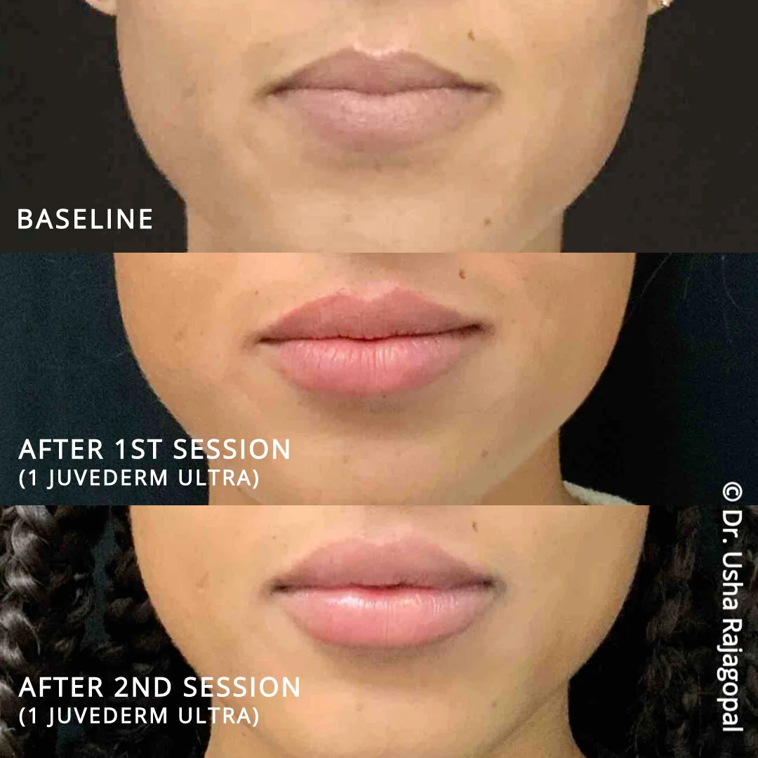 Bay Area Lip Augmentation plump, organic and healthy lips Usha Rajagopal, MD