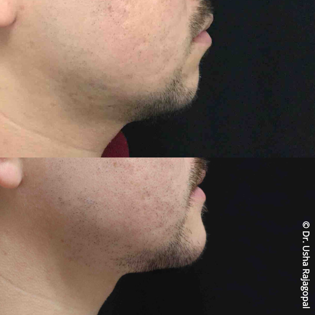 chin implant_ba1.jpg