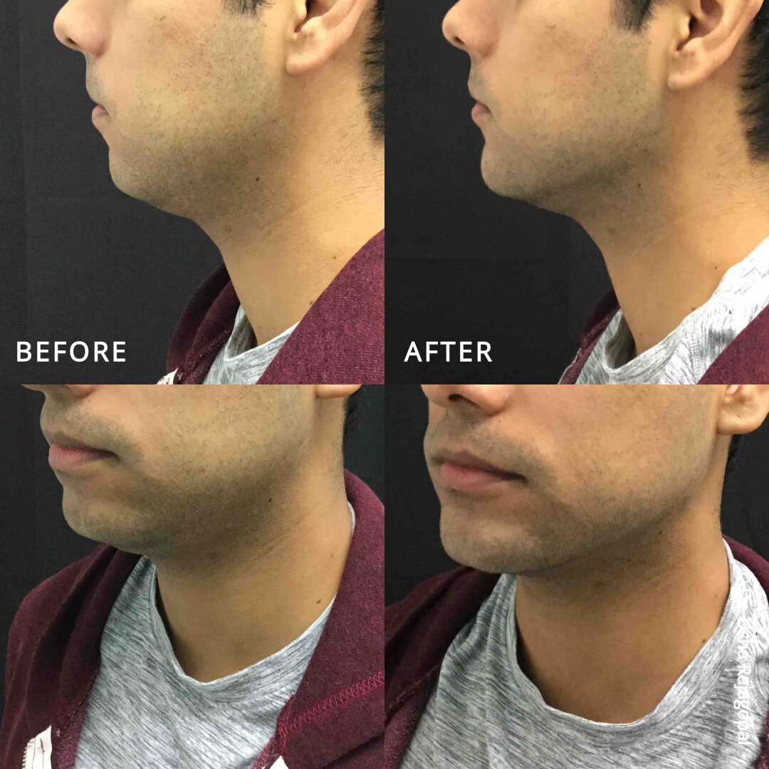 jawline contouring for men - Jeune Ascot Vale