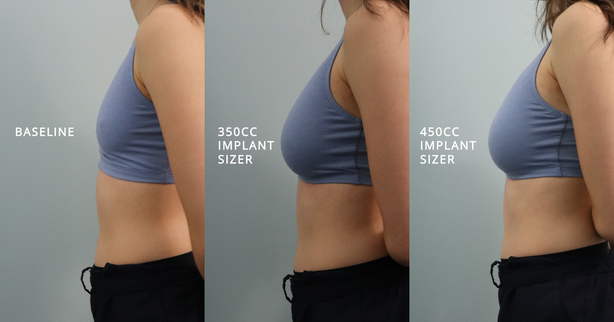 What To Expect At Your Breast Augmentation Consultation Usha Rajagopal Md