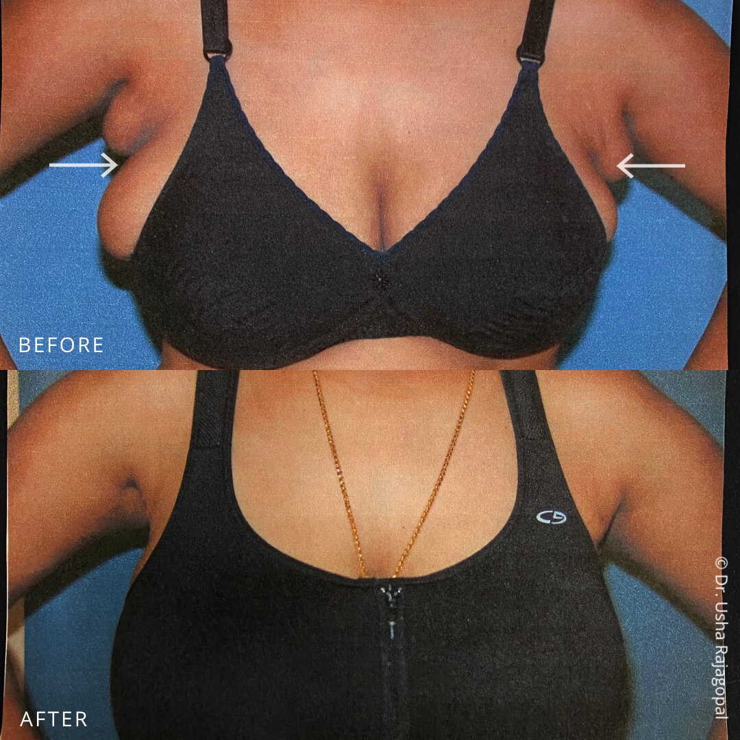 Armpit Fat Removal with Kybella