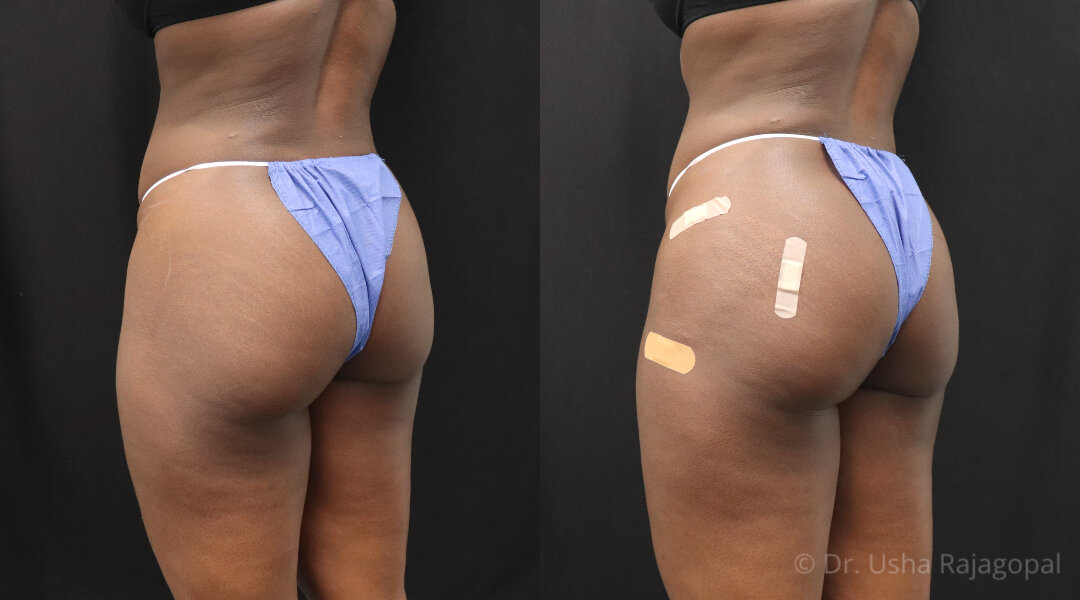 Sculptra Butt Lift (BBL) Injections