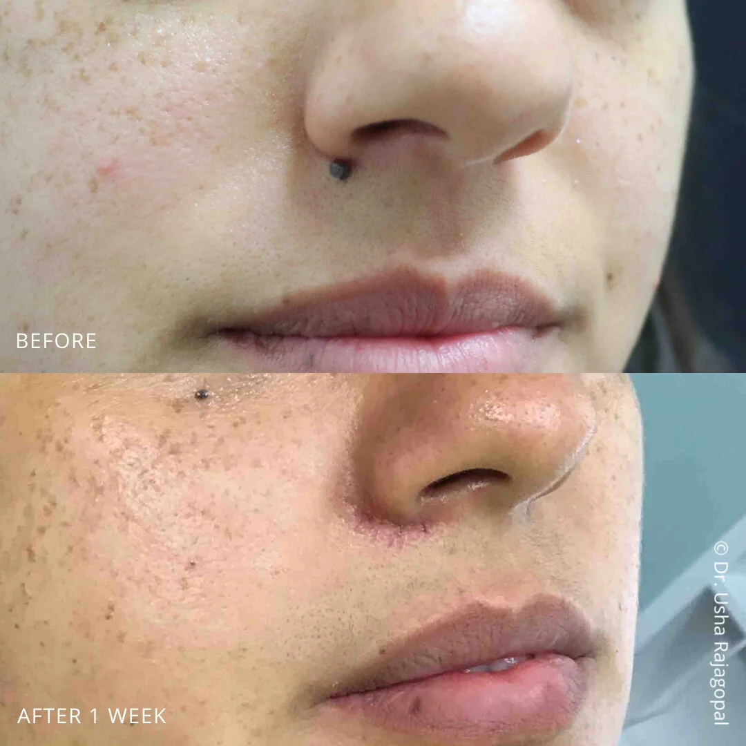 Mole Removal Usha Rajagopal, MD