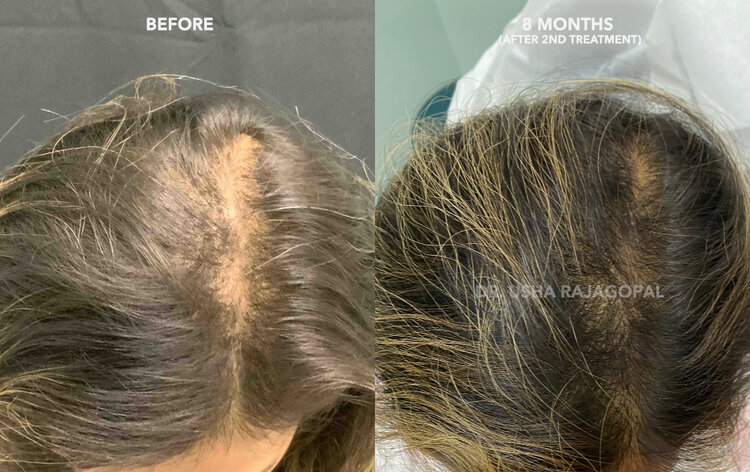 Hair Regrowth Therapy with ACell + PRP | San Francisco Bay Area | Usha  Rajagopal, MD