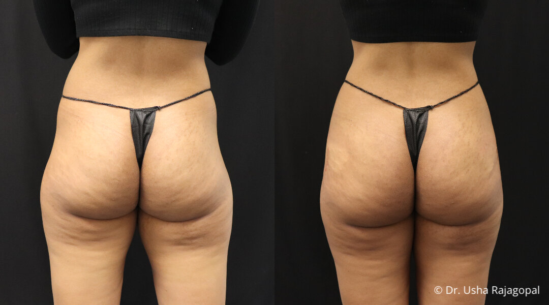 Top 3 Non-Surgical Butt Lift Treatments in San Francisco