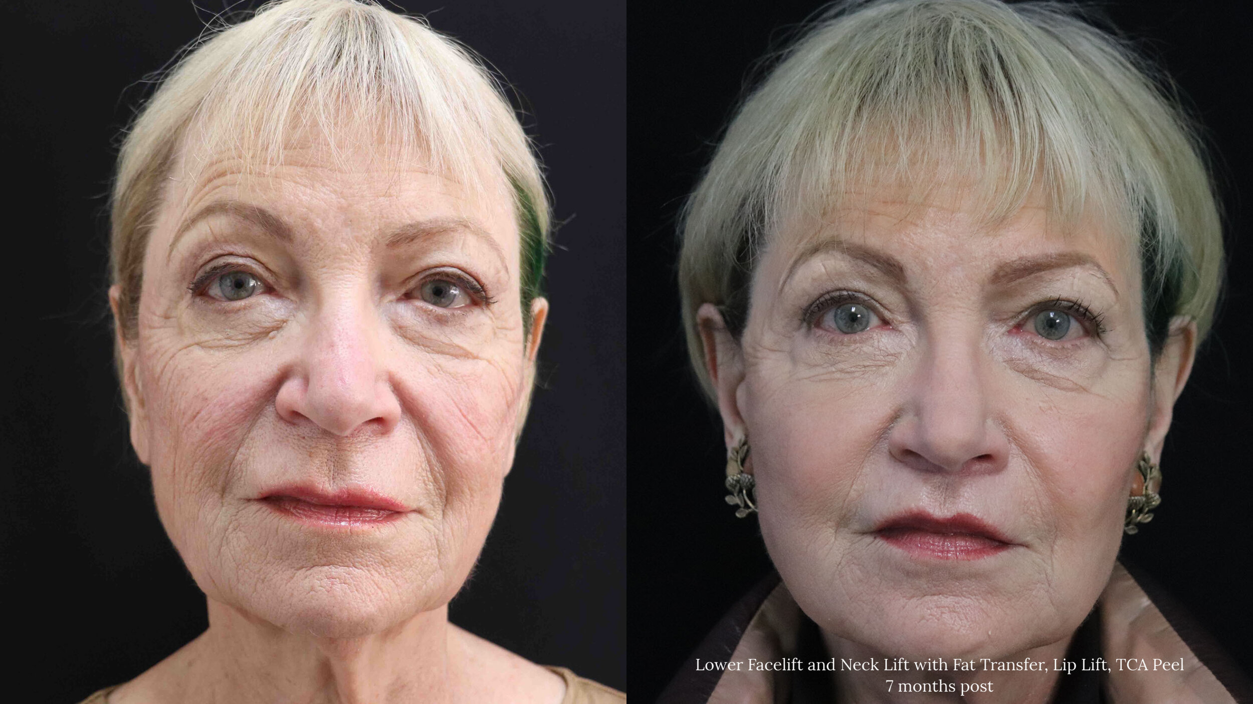 Lower Face and Neck Lift_3.2.jpg