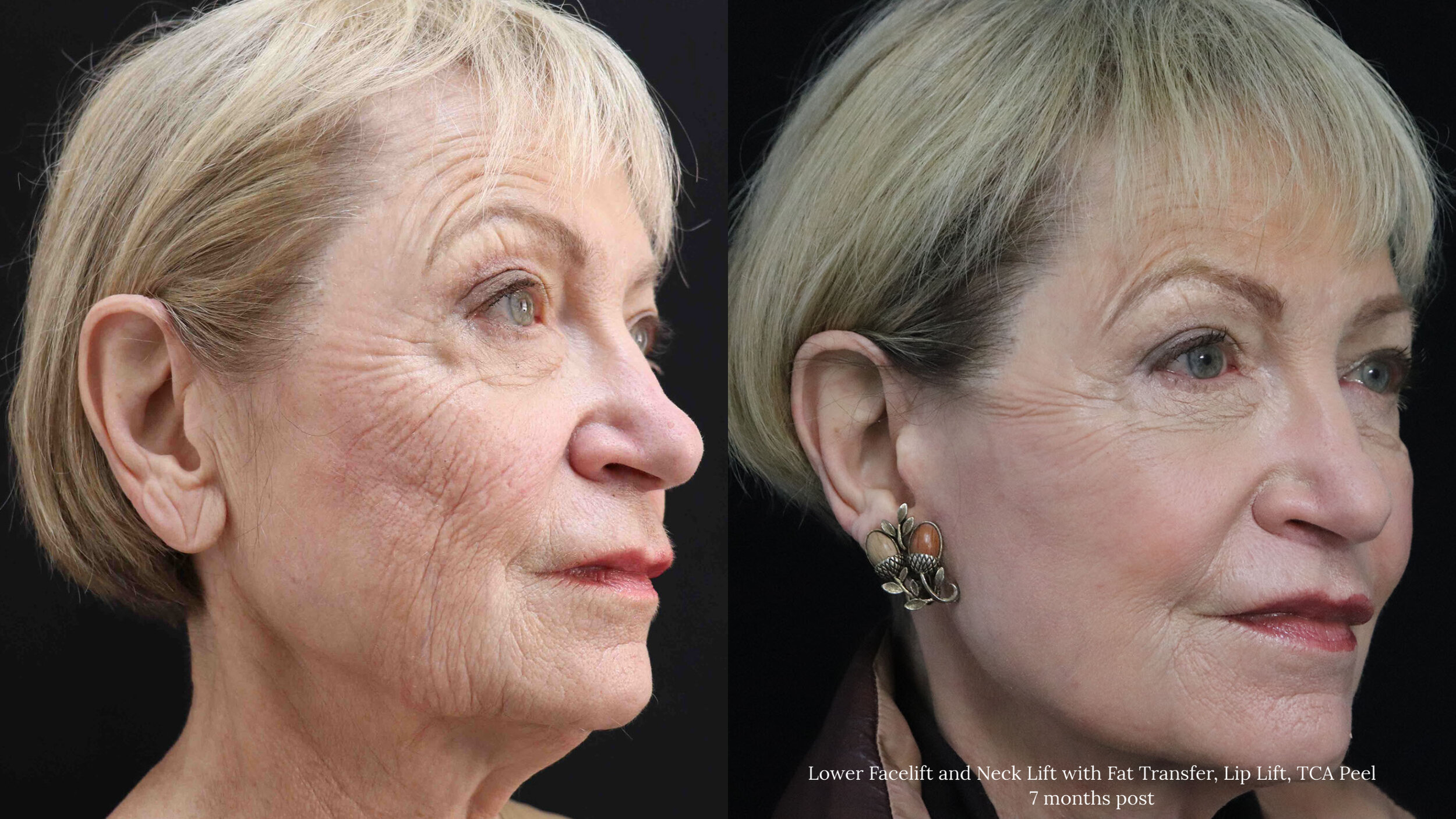 Lower Face and Neck Lift_3.1.jpg