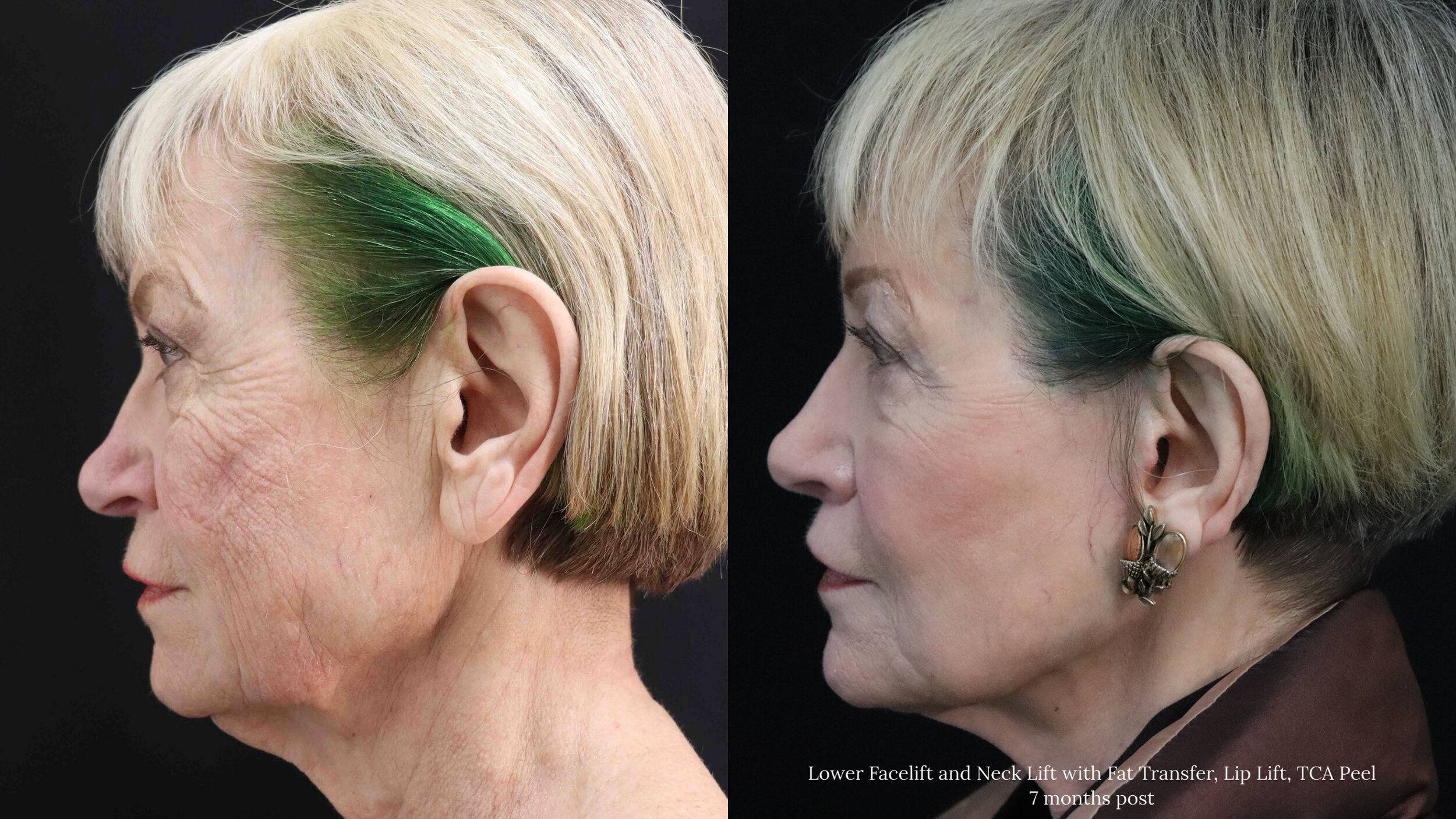 Lower Face and Neck Lift_3.3.jpg