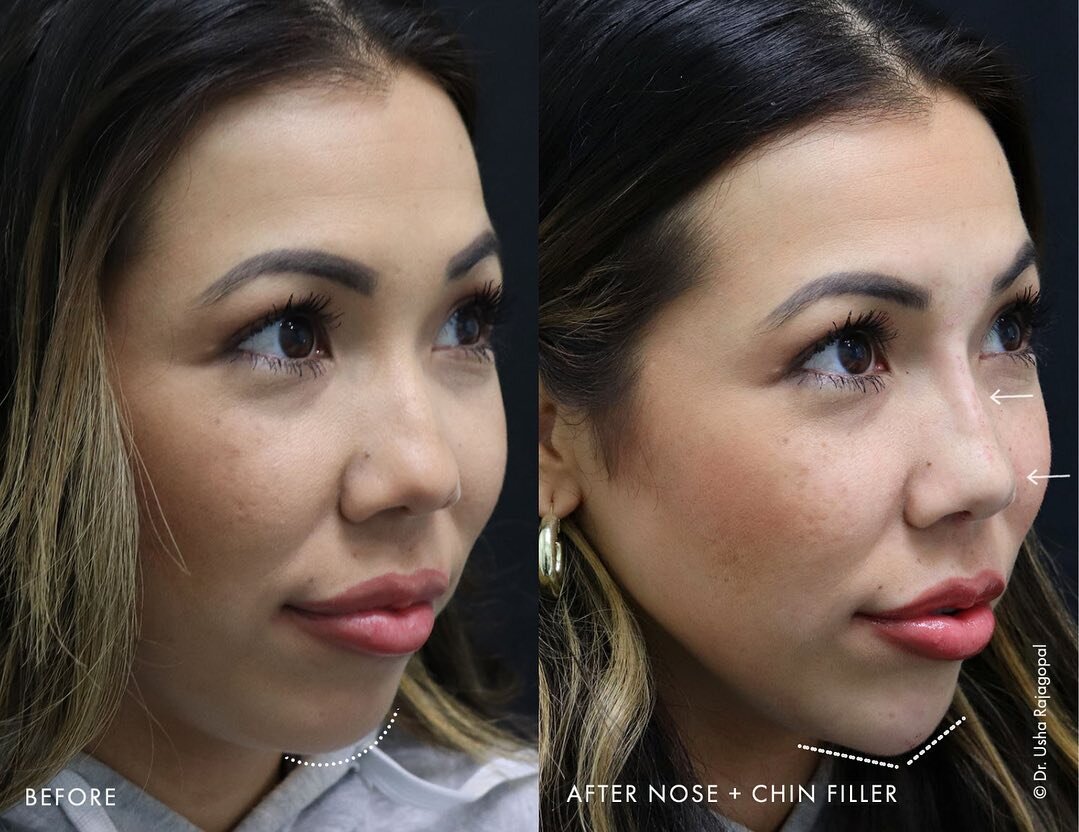 Mommy Makeover Before and After Photos Usha Rajagopal, MD