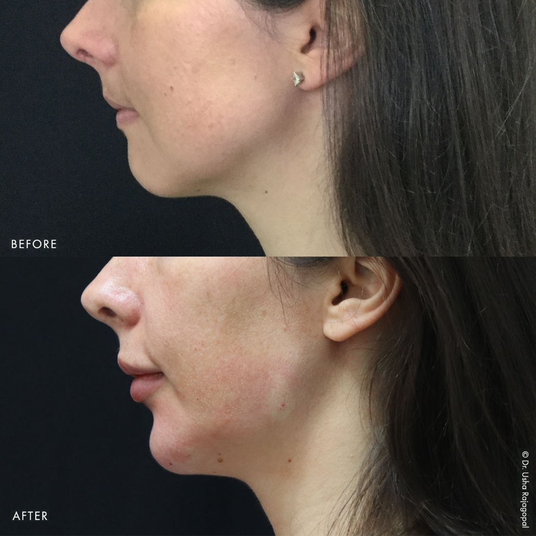 jaw filler_radiesse_ba_12.jpeg