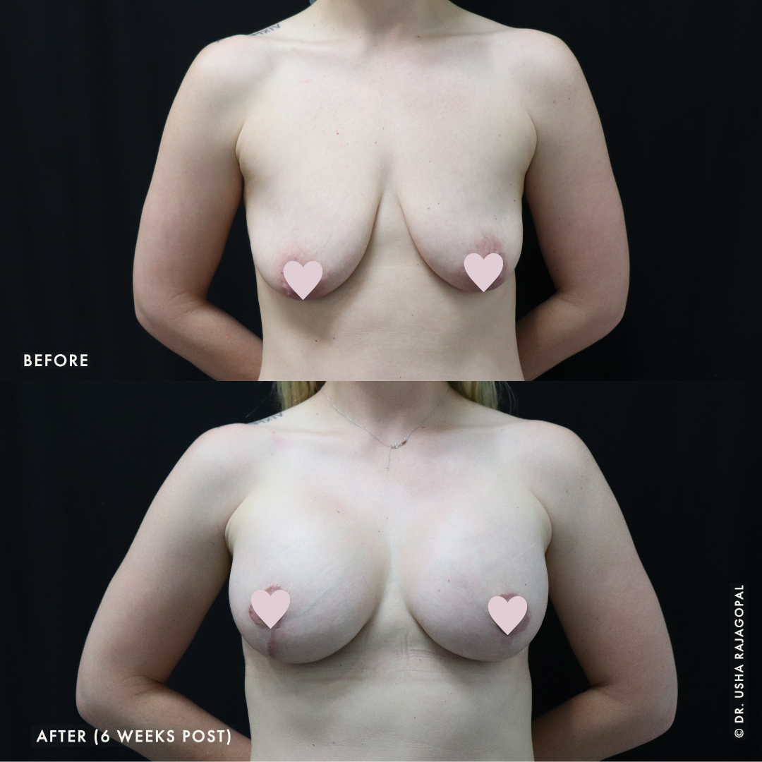 breast-aug-lift_ba_17_ig.png