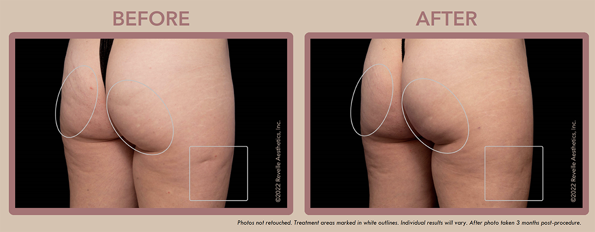 Aveli Cellulite Before After Photos_1.png