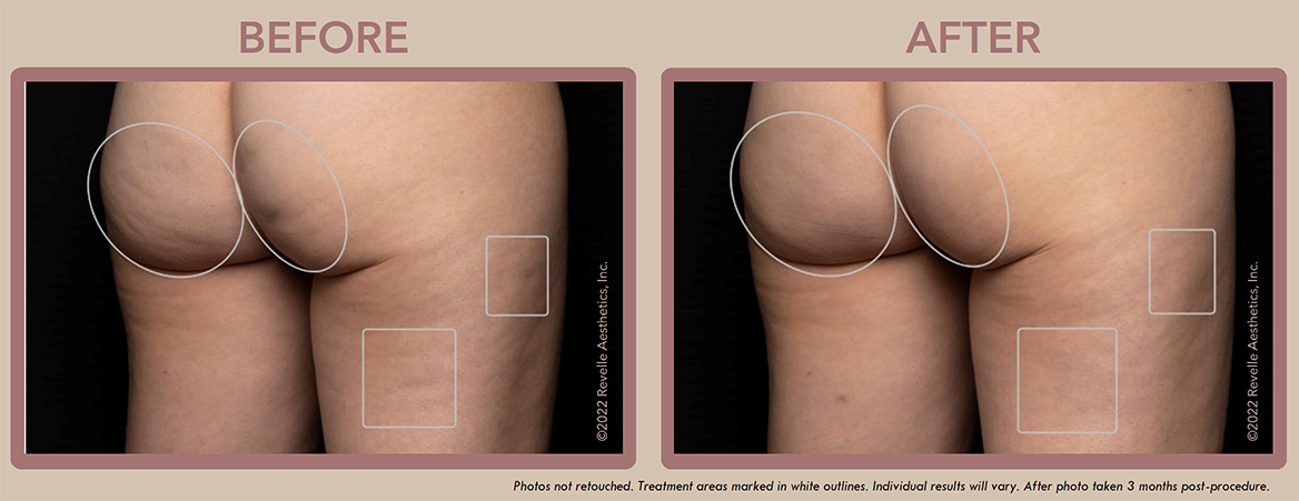 Aveli Cellulite Before After Photos_3.png