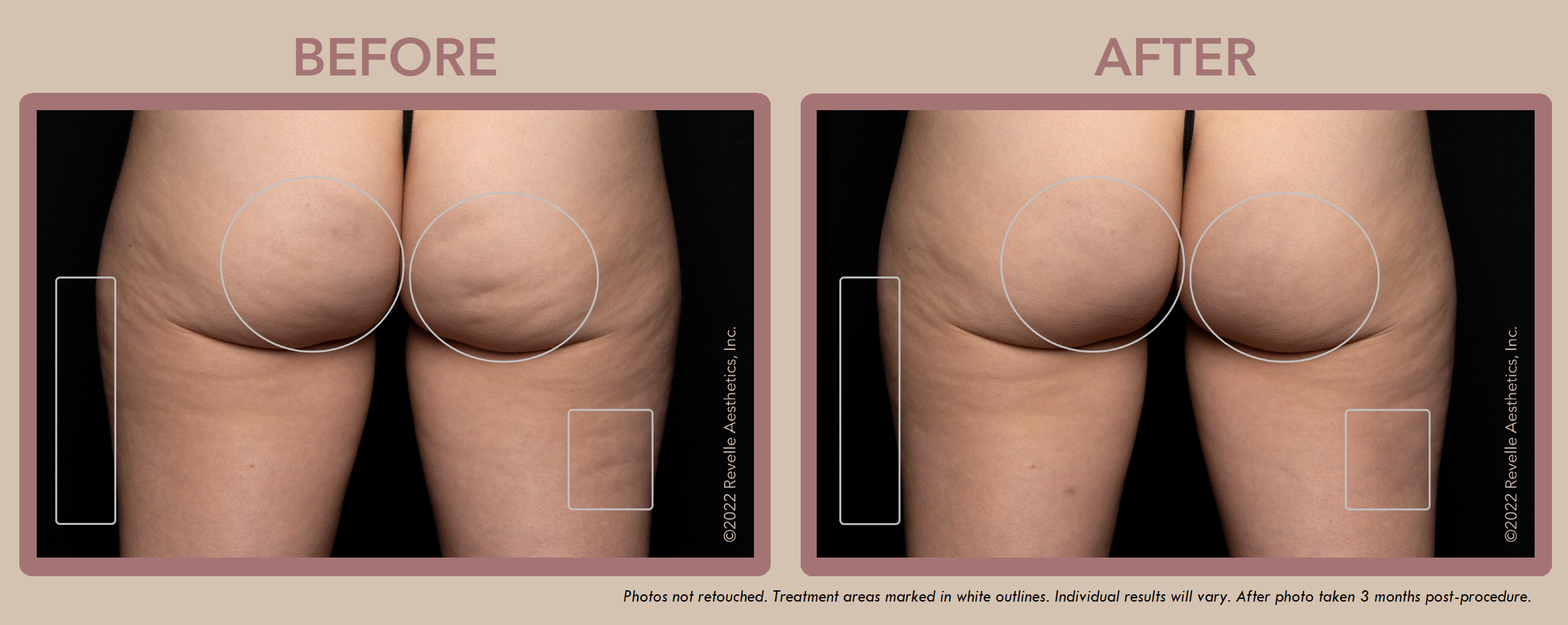 Aveli Cellulite Before After Photos_2.png