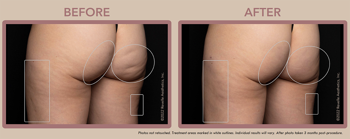 Aveli Cellulite Before After Photos_4.png