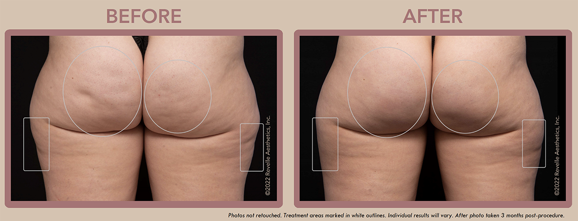 Aveli Cellulite Before After Photos_5.png