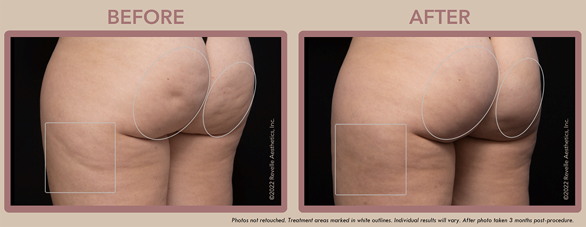Aveli Cellulite Before After Photos_6.png