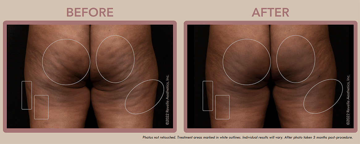 Aveli Cellulite Before After Photos_7.png