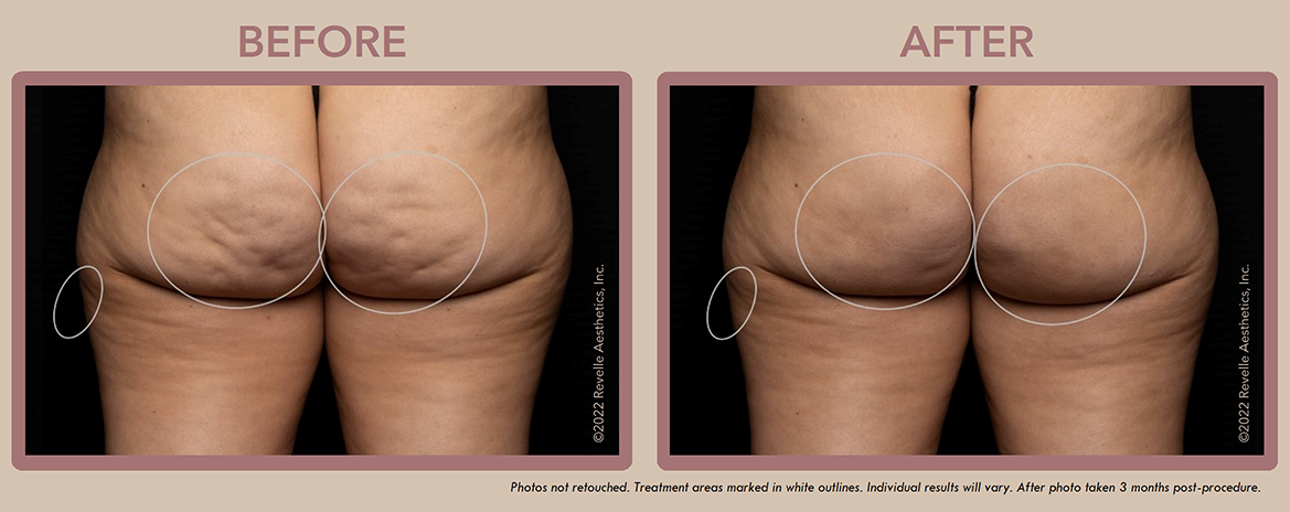 Aveli Cellulite Before After Photos_8.png