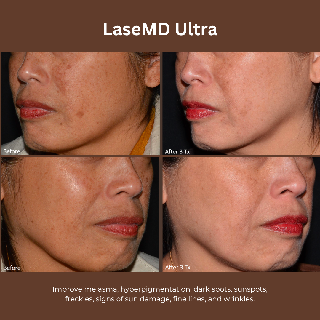 LaseMD San Francisco Melasma6.png