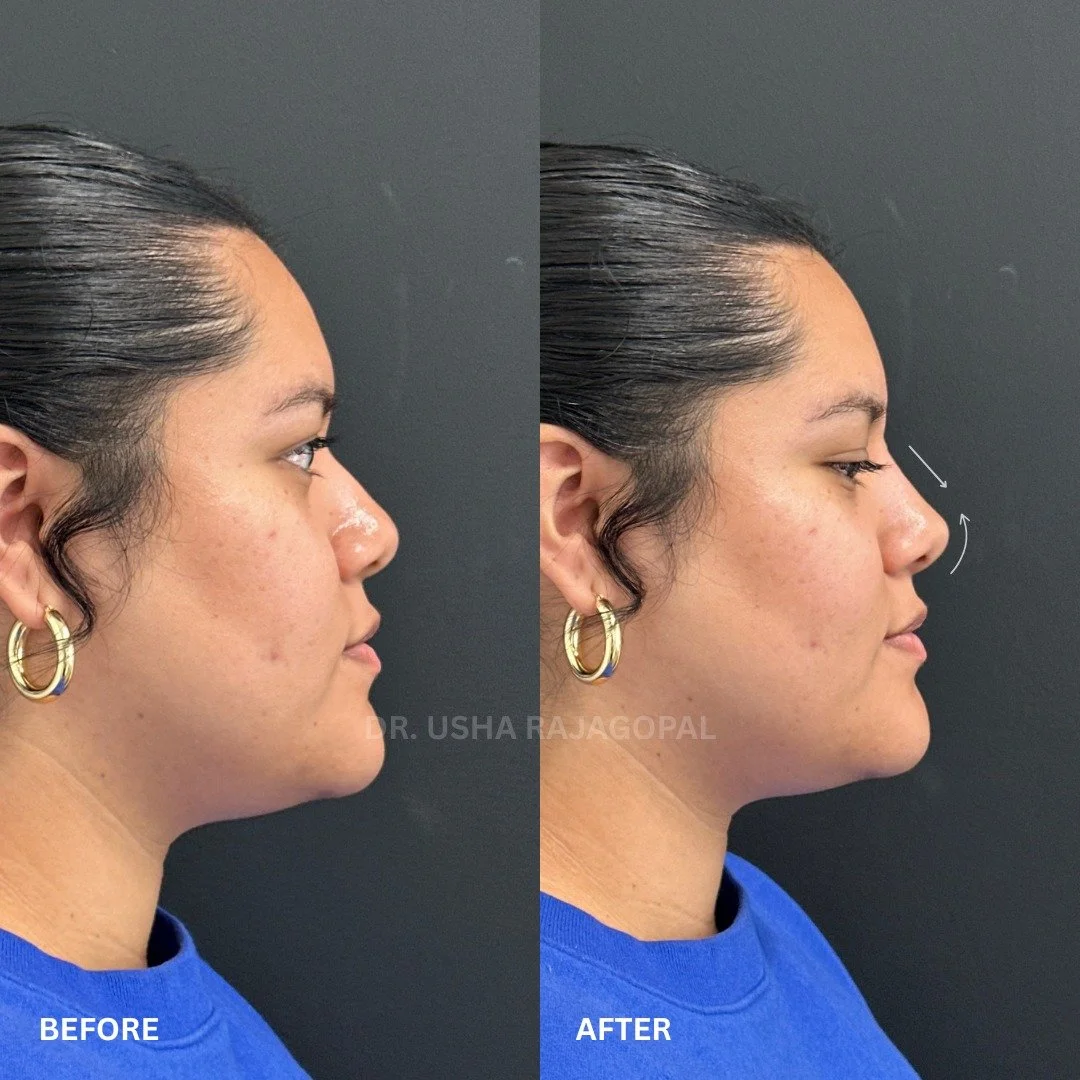 A more sculpted, balanced nose without surgery? It is possible with nose filler.

Our non-surgical nose enhancement takes just 15 minutes, involves no downtime, and offers immediate results.

💉 What can be achieved with filler:

✔️ Camouflage a nasa