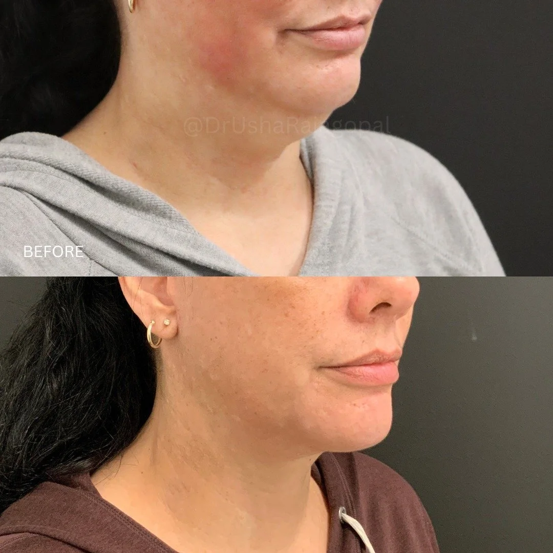 Check out the amazing results (4 months post-op) of a lower facelift and neck lift on our lovely patient!