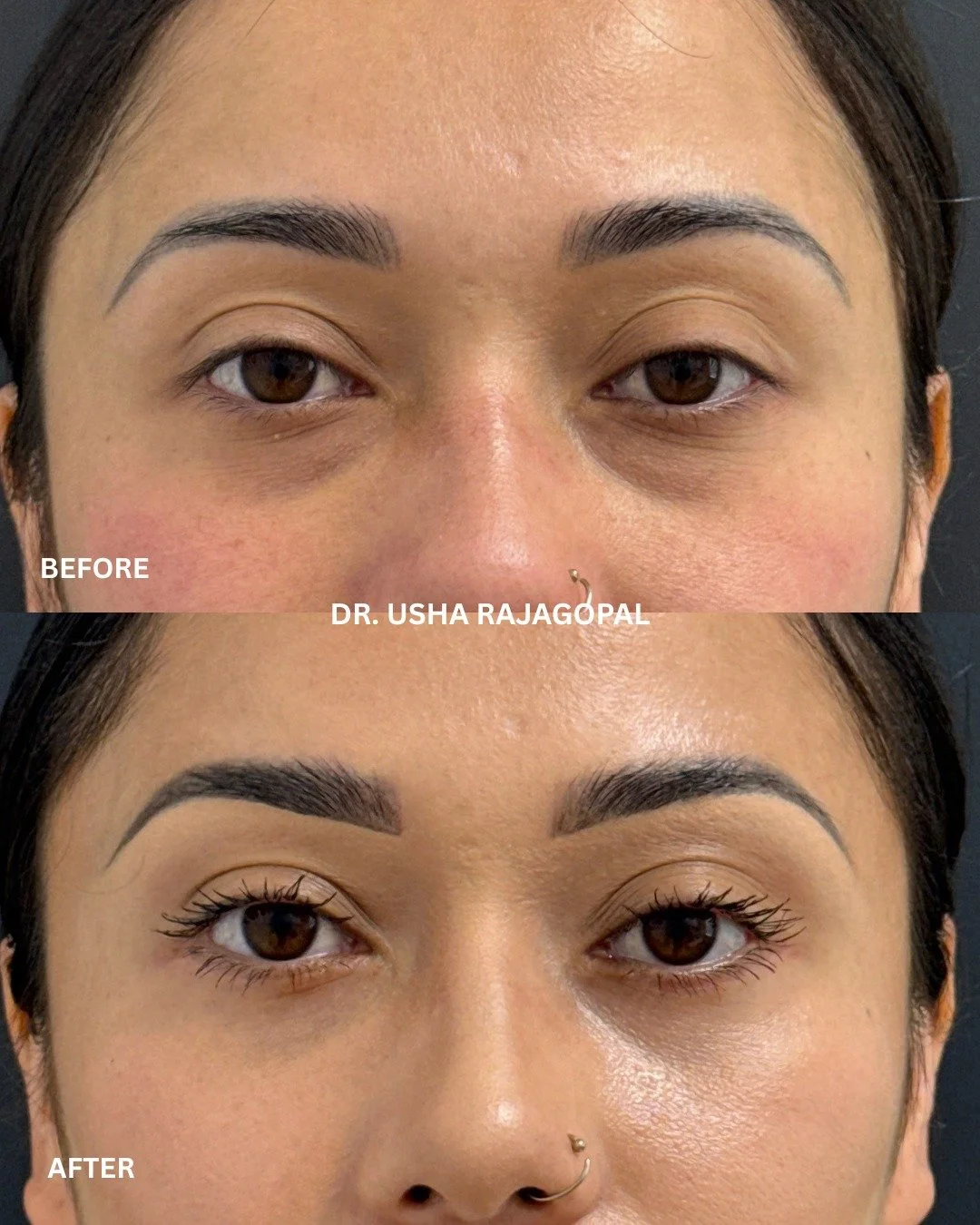 Six weeks after her lower blepharoplasty, this patient looks rested, youthful, and naturally rejuvenated.

Interested in under-eye rejuvenation (surgical or non-surgical)? Send us a DM or email us at hello@sfcosmeticsurgery.com to get started!