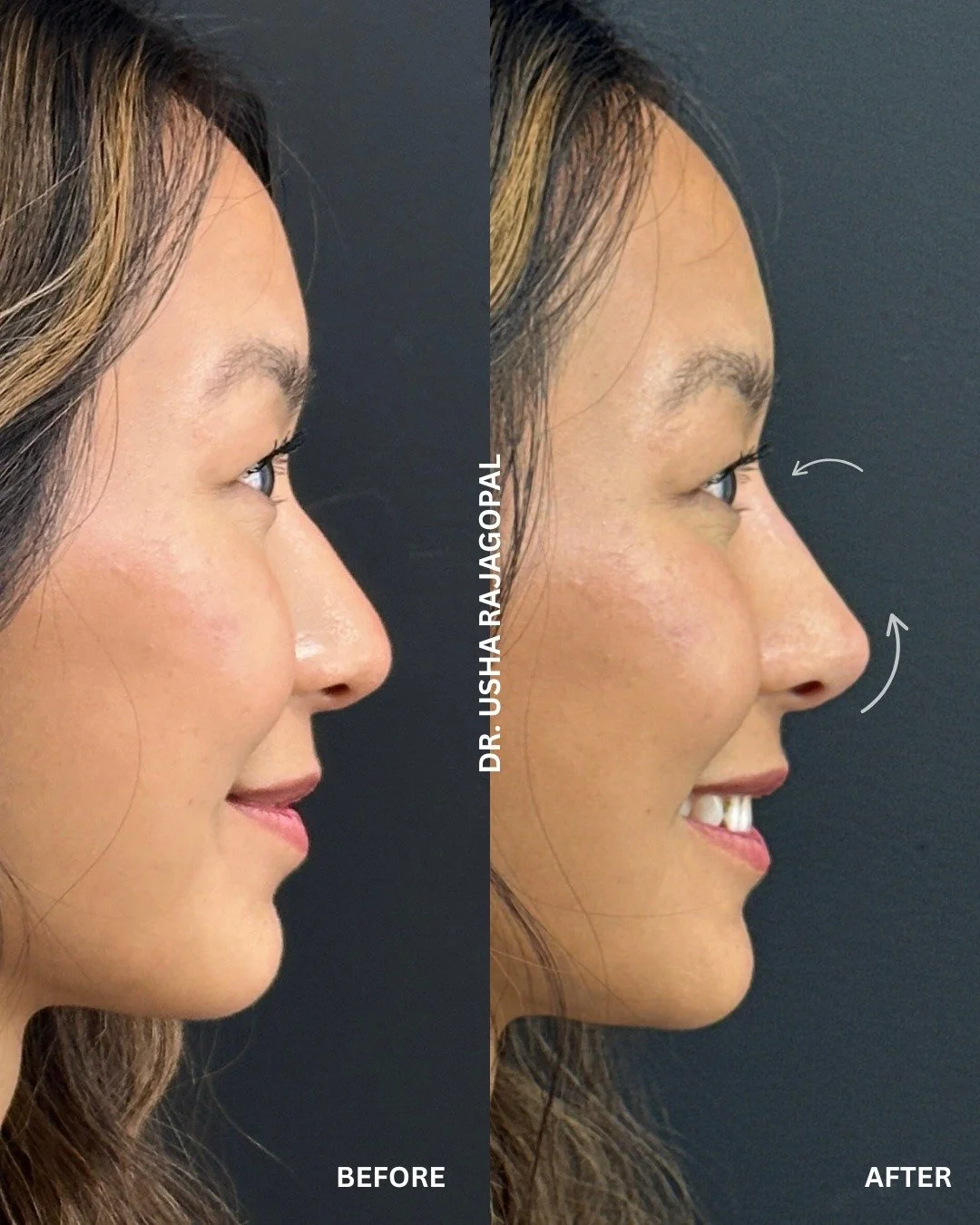 Can nose filler really change the shape of your nose in just minutes? Absolutely.

No surgery. No downtime. Just instant, natural-looking results in under 15 minutes.

Here is what we can do with a non-surgical nose job:
✔️ Make a bump look smoother 