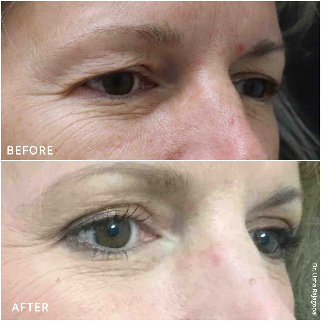✨ Brighter, refreshed eyes ✨

This patient underwent upper eyelid surgery (#blepharoplasty) to remove excess skin and restore a more youthful, rested look. Notice how her eyes appear more open and defined in the after photo.

Benefits of upper blepha