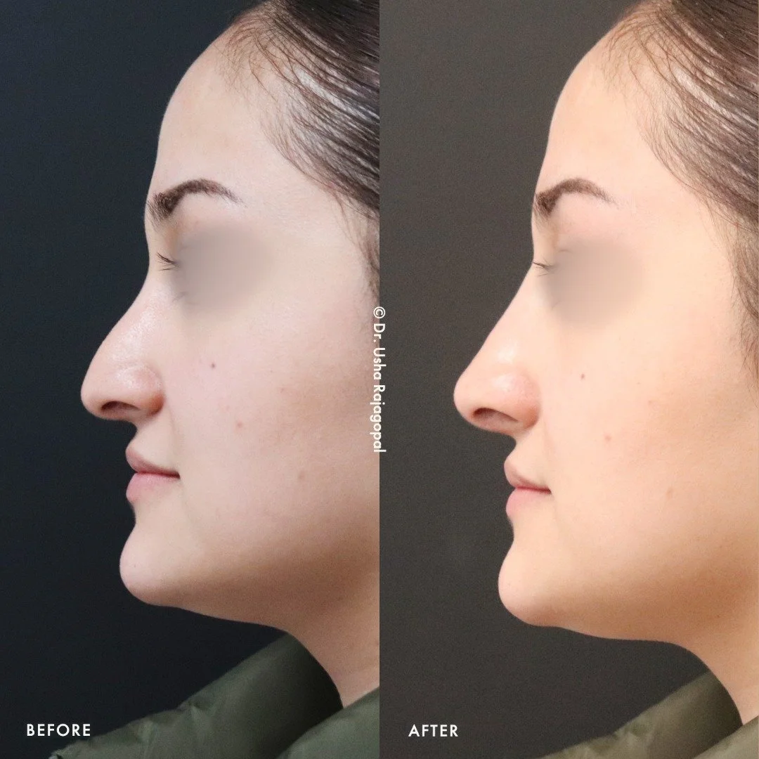 A more sculpted, balanced nose without surgery? It is possible with nose filler.

Our non-surgical nose enhancement takes just 15 minutes, involves no downtime, and offers immediate results.

💉 What can be achieved with filler:

✔️ Camouflage a nasa