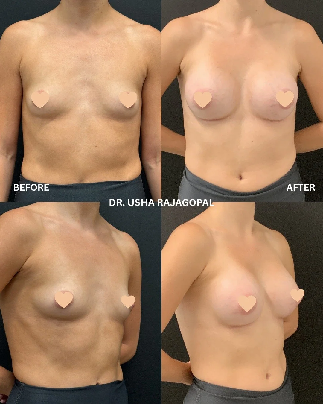 Six weeks after breast augmentation with 300cc Motiva ERSD implants, placed subfascially. On a petite frame (5'2&quot;, 115lbs), careful sizing, pocket control, and subfascial positioning create natural, centered fullness without an overfilled look. 