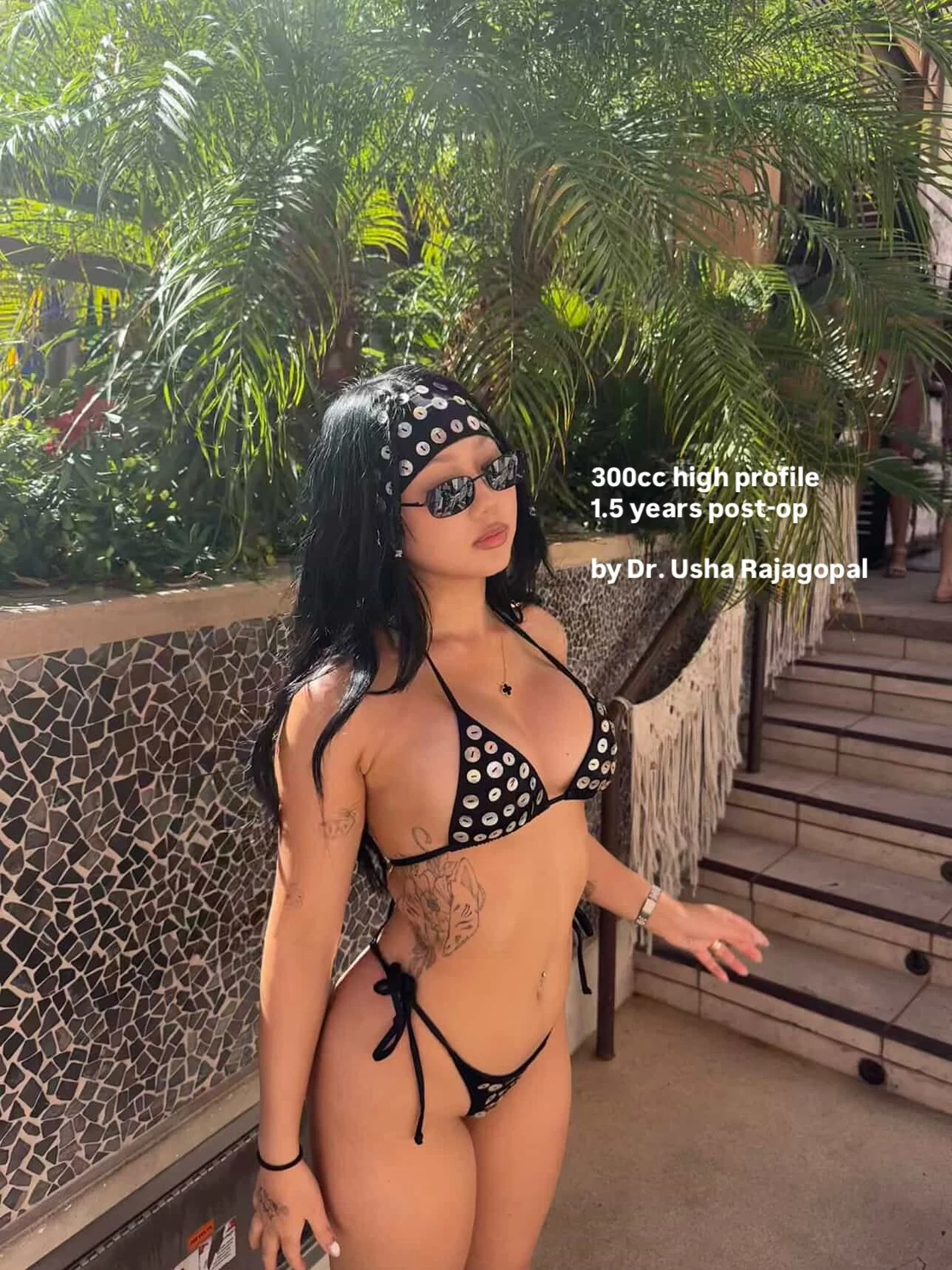 Our gorgeous patient over 1.5 years post-op! 🔥👙 She received 330cc high profile breast implants. #BreastsByDrUsha

💸 Financing for Breast Augmentation

Planning on getting a breast augmentation? Right now is the best time to get it done! We are of