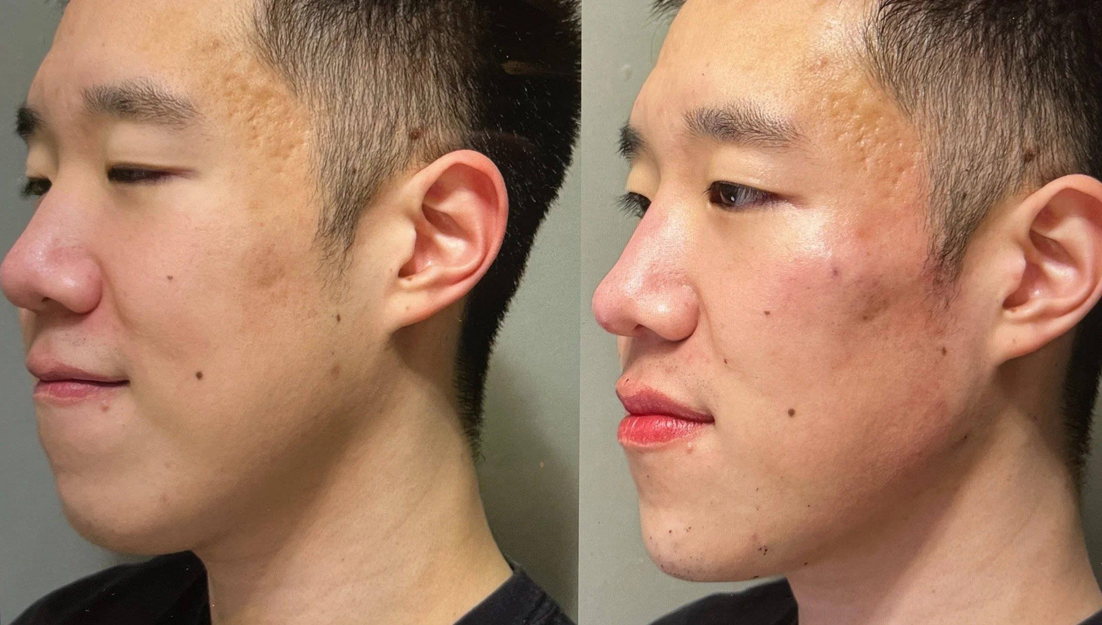 When we talk about facial balancing for men, it is really about structure. This patient's treatment included:

&bull; Creating a stronger jawline
&bull; Enhancing the chin to improve facial proportions
&bull; Supporting the midface by treating the py