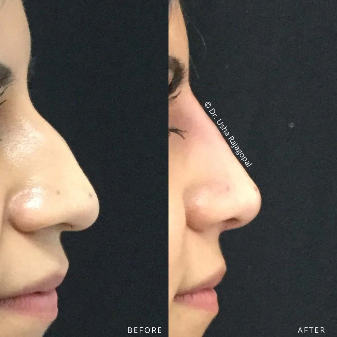 A more sculpted, balanced nose without surgery? It is possible with nose filler.

Our non-surgical nose enhancement takes just 15 minutes, involves no downtime, and offers immediate results.

💉 What can be achieved with filler:

✔️ Camouflage a nasa