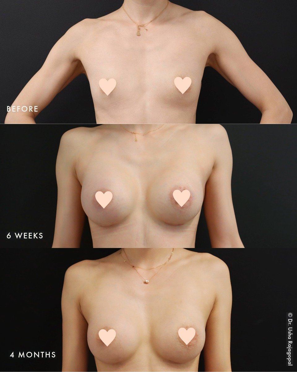 How do breast implants settle naturally over time? Here's a great example of our breast augmentation patient at 6 weeks post-op and then at 4 months post-op. Notice how the implants nicely drop and fluff, and they will continue to look better within 