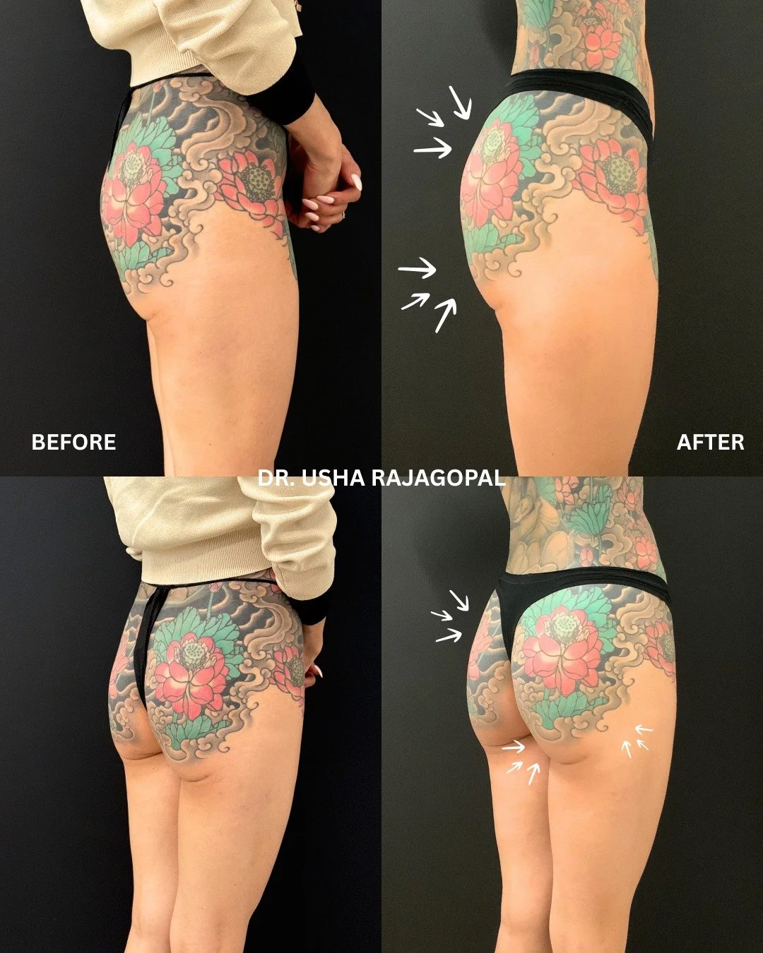 Are you looking for a non-surgical option to enhance your butt or even out your hip dips? Our office offers the Radiesse Butt Lift, which is a non-surgical alternative to the traditional surgical Brazilian Butt Lift (BBL). Radiesse is made of calcium