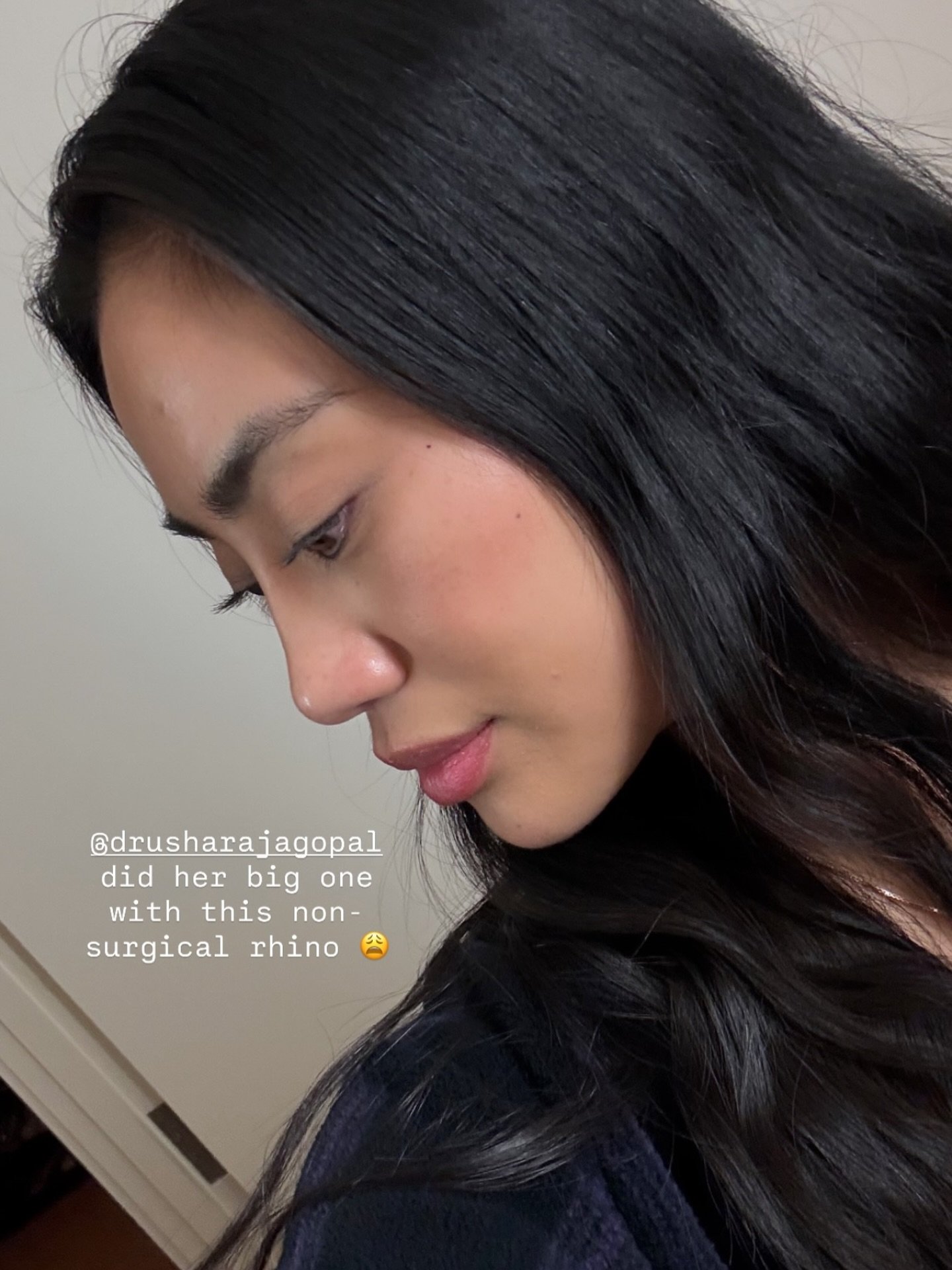 Immediate results after nose filler 💉✨ #nosebydrusha