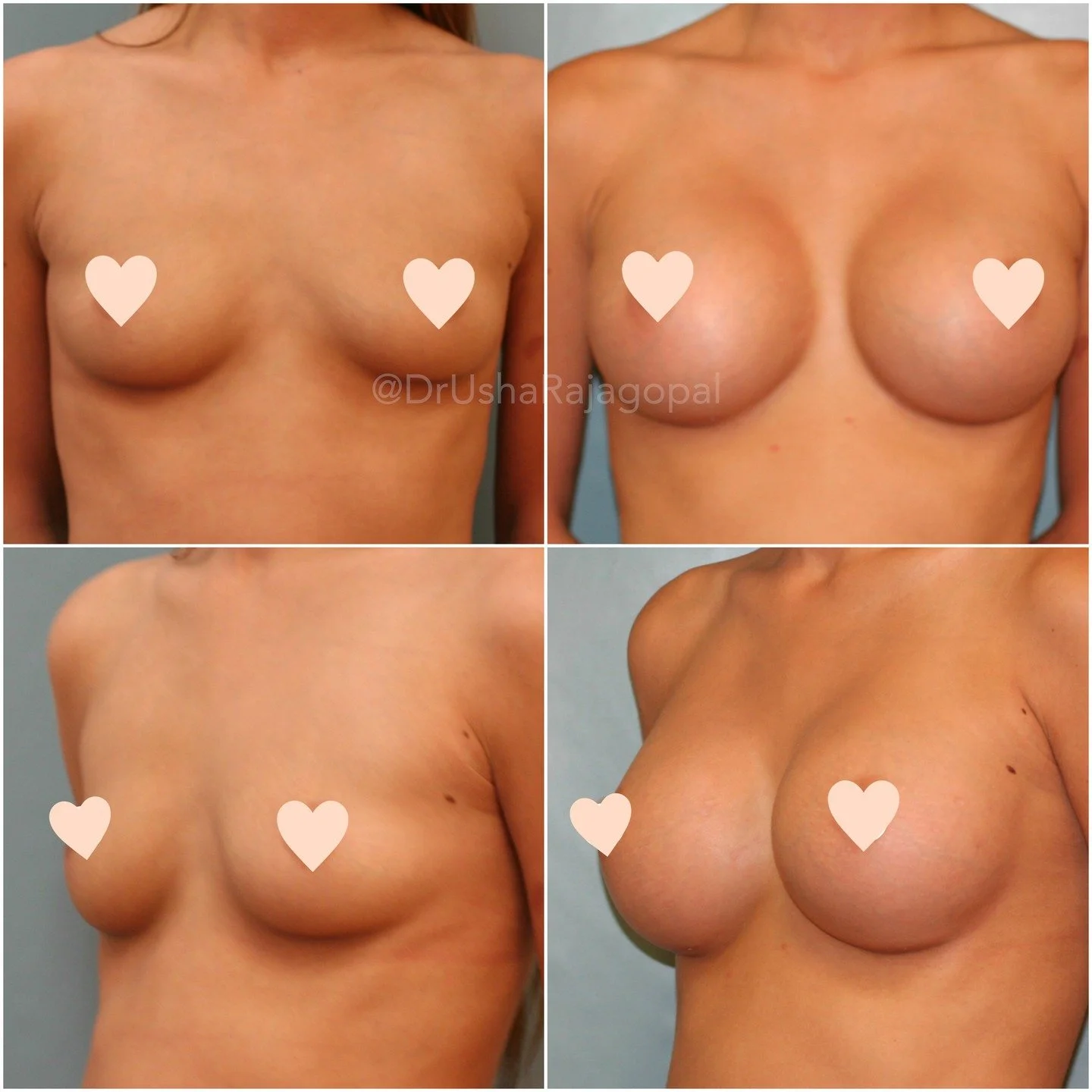 Beautiful shape and volume! 410cc implants 👙 #BreastsByDrUsha