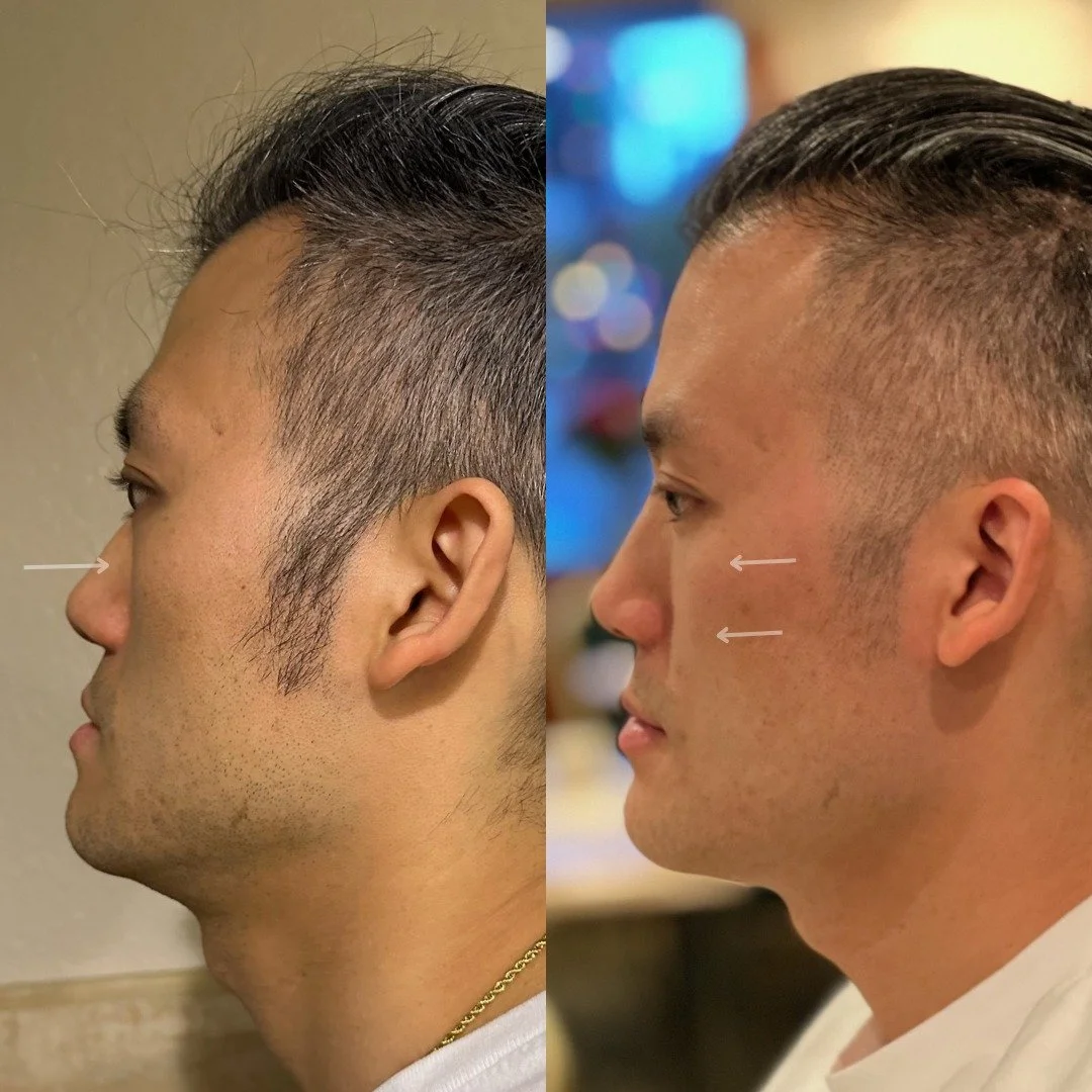 FULL FACIAL BALANCING: 

This young gentleman has maxillary hypoplasia (a recessed midface). From the front, his mid-cheek looked flatter even though his outer cheekbones were strong. That lack of support can also create under-eye shadowing and make 