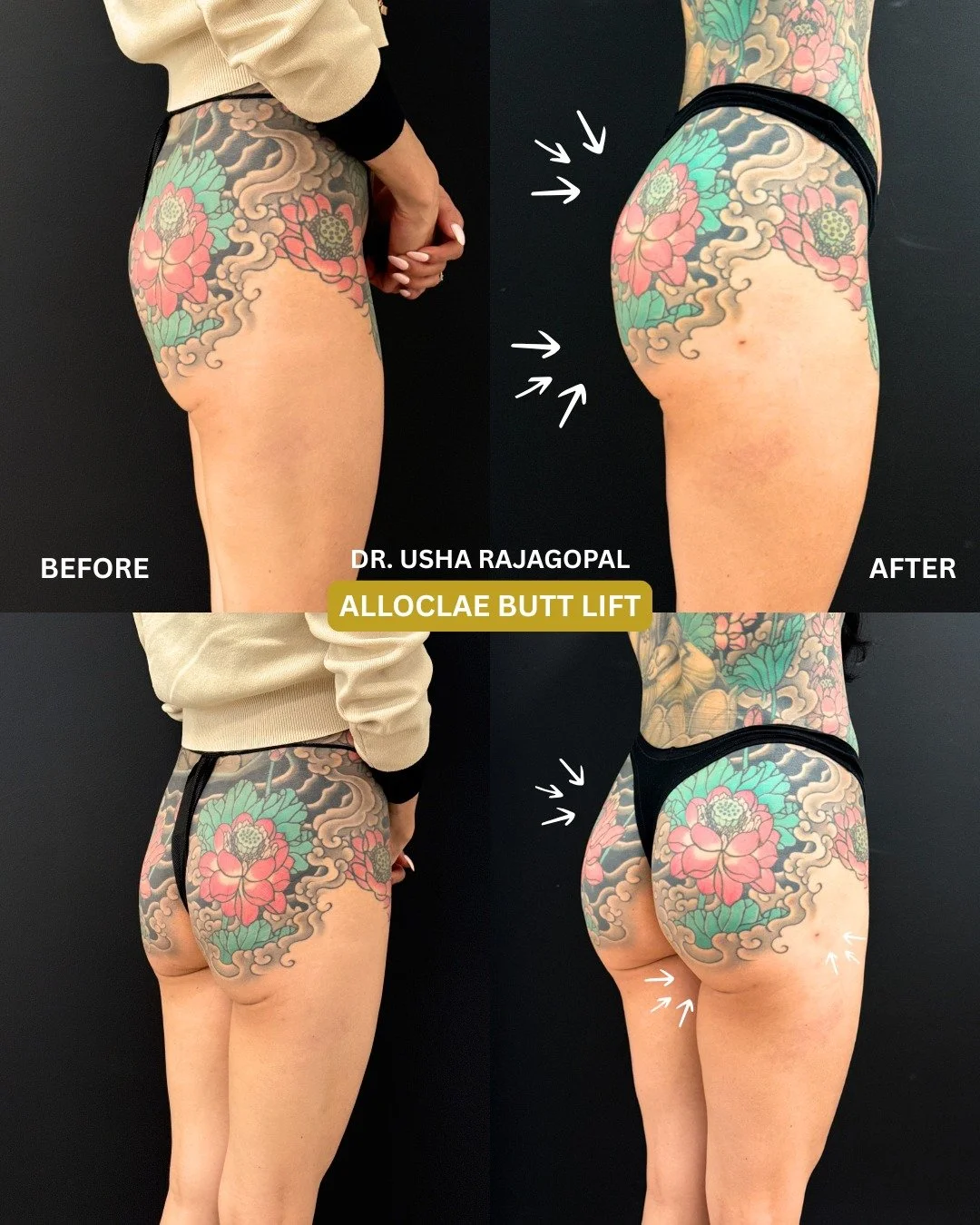 Many of you have been asking for #Alloclae before-and-after photos, so we are excited to finally share this follow-up.

This is our patient's non-surgical Alloclae BBL-style enhancement to improve overall shape, projection, and hip dip contour. Swipe