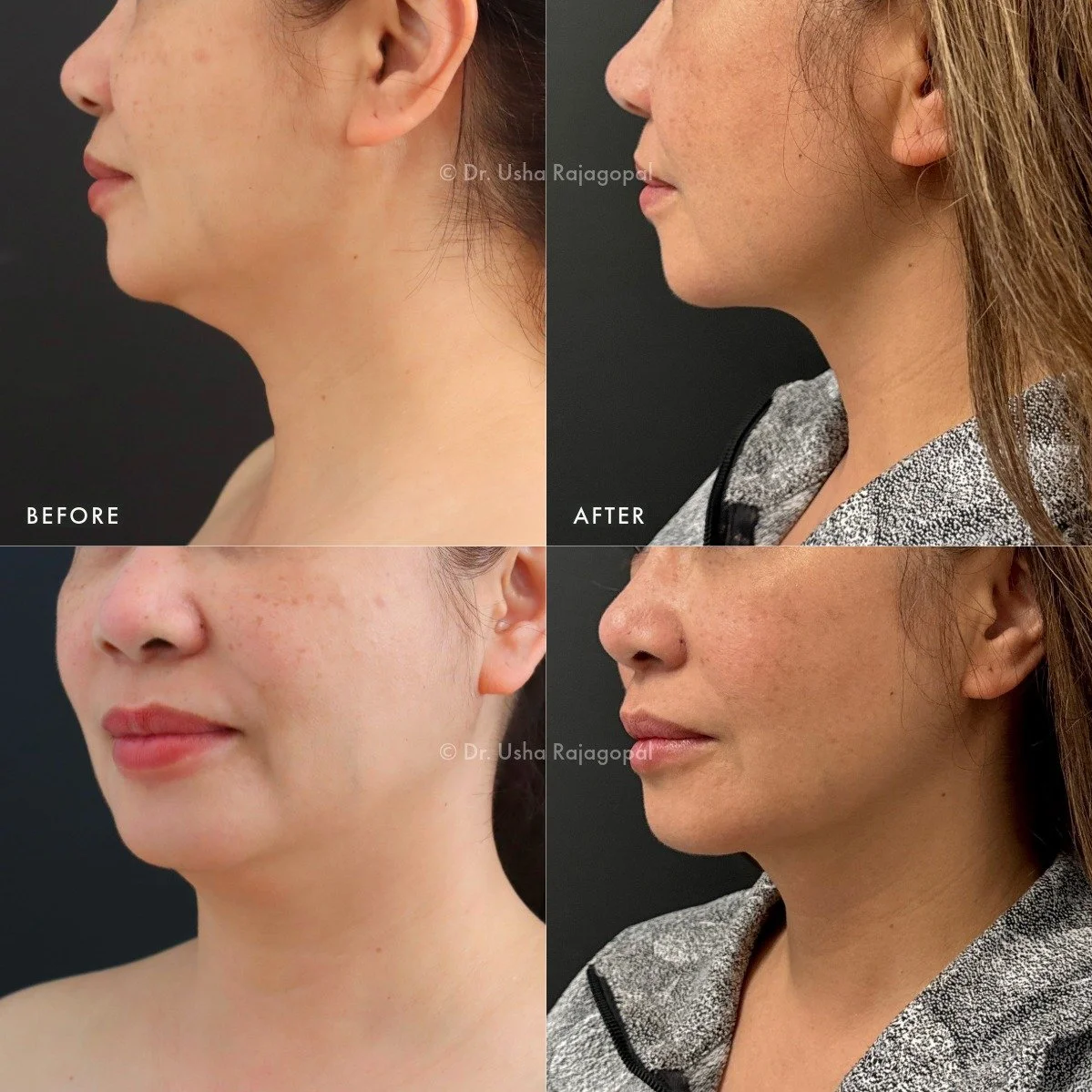 Interested in refining your jawline? Send us a DM to learn more about our signature AirContour Lipo&trade; procedure and see if it&rsquo;s right for you.

Chin liposuction helps improve the definition of the jawline, contour of the chin, and minimize
