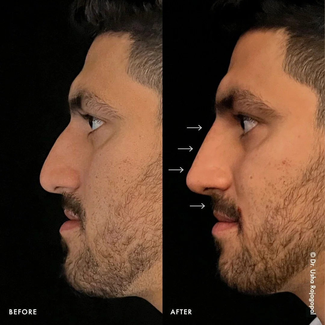 PROFILE BALANCING FOR MEN ⚖️

This handsome patient received a non-surgical rhinoplasty to balance out his entire nasal bridge. We also injected dermal filler into the upper body of the lip (maxilla) &mdash;not the pink of the lip&mdash;to bring the 